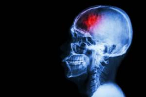 Critical Illness: Stroke, RS Awal Bros Evasari