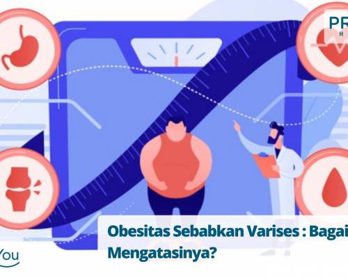 Obesitas Sebabkan Varises Bagaimana Mengatasinya