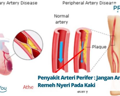 Penyakit Arteri Perifer Jangan Anggap Remeh Nyeri Pada Kaki