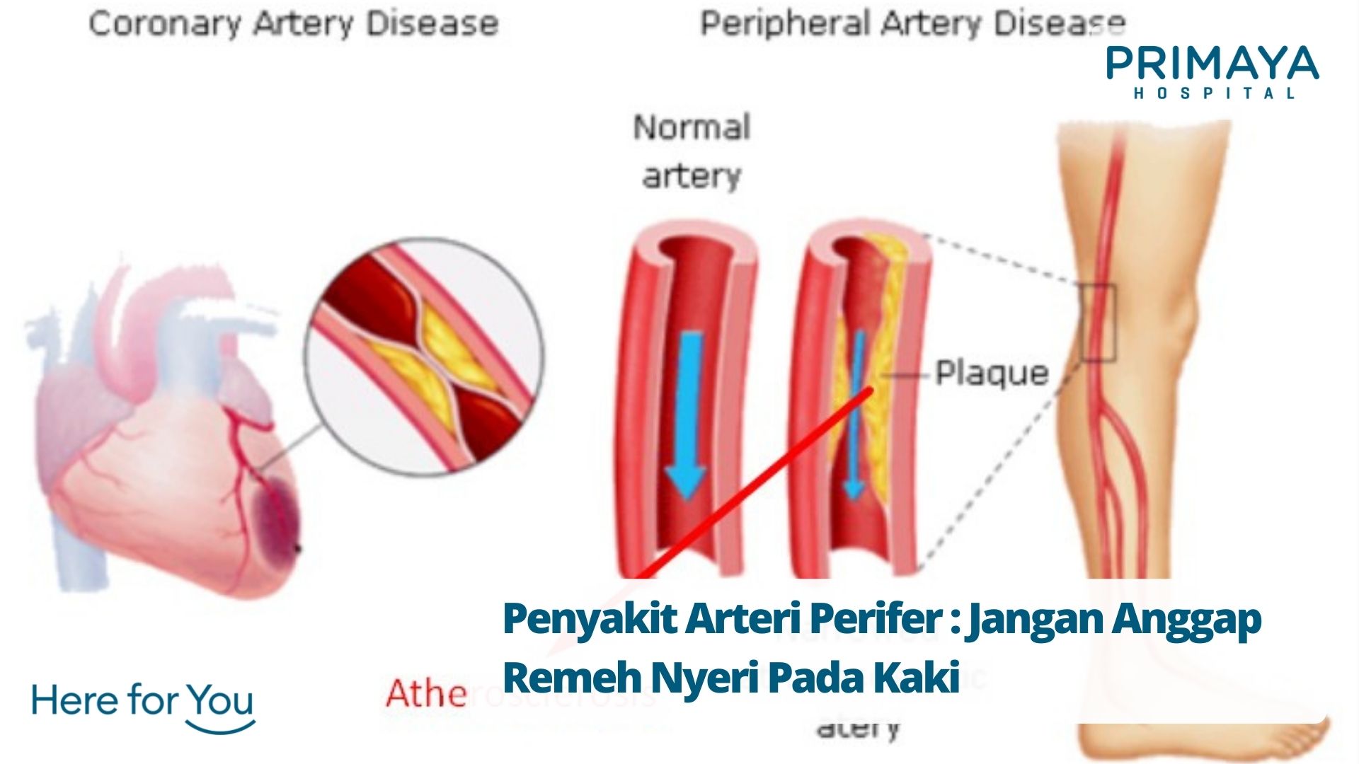 Penyakit Arteri Perifer Jangan Anggap Remeh Nyeri Pada Kaki