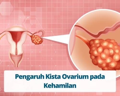Pengaruh Kista Ovarium pada Perkembangan Janin Masa Kehamilan