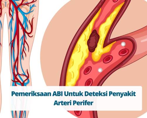 Pemeriksaan ABI Untuk Deteksi Penyakit Arteri Perifer