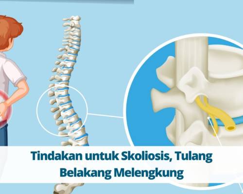 Tindakan untuk Skoliosis, Tulang Belakang Melengkung
