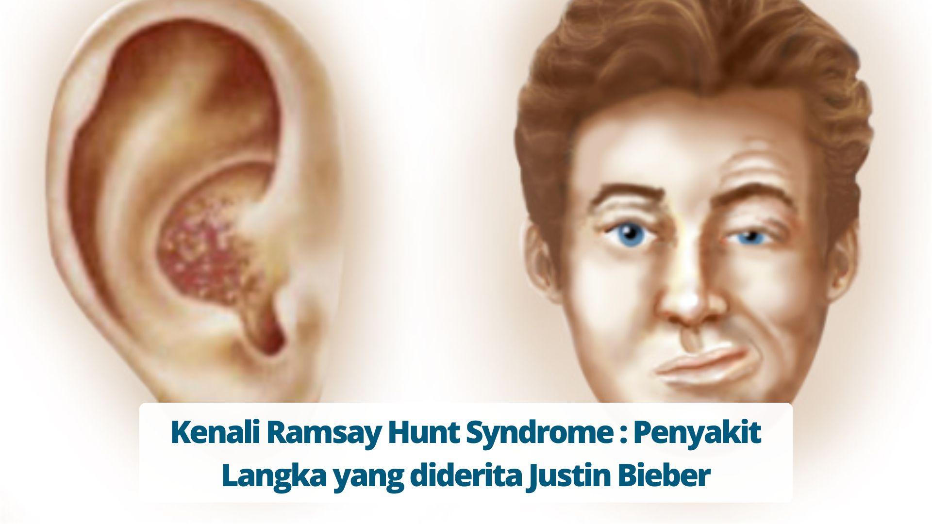 Kenali Ramsay Hunt Syndrome Penyakit Langka yang diderita Justin Bieber