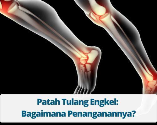 Patah Tulang Engkel Bagaimana Penanganannya