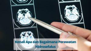 Kenali Apa dan Bagaimana Perawatan Hidrosefalus