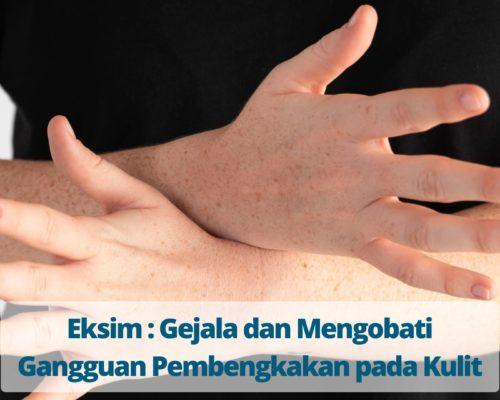 Eksim Gejala dan Mengobati Gangguan Pembengkakan pada Kulit