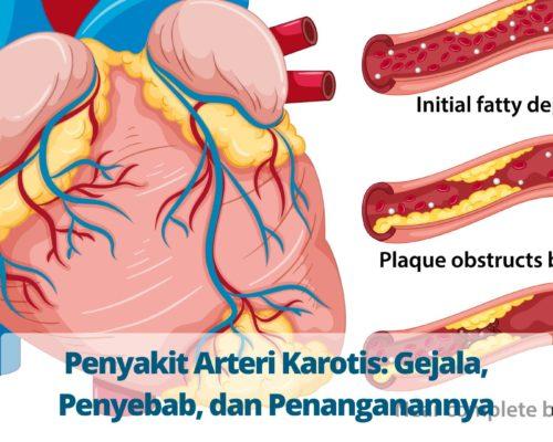 Penyakit Arteri Karotis Gejala, Penyebab, dan Penanganannya