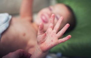 Flu Singapura pada anak