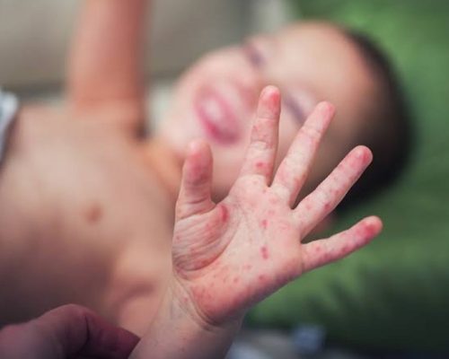 Flu Singapura pada anak