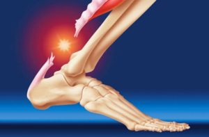 tendon kaki robek