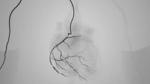PTA (Percutaneus Transluminal Angiography)