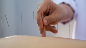 Akupunktur Medis, Pahami Manfaatnya Bagi Kesehatan Tubuh