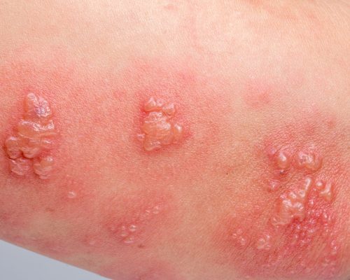 Kenali Herpes Zoster (Cacar Api/Dompo) dan Penanganannya