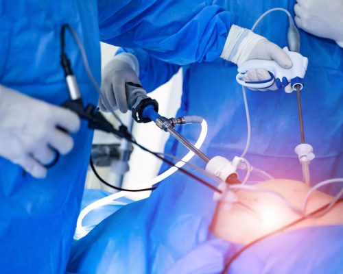 Laparoscopy Teknik Bedah Minimal Invasif