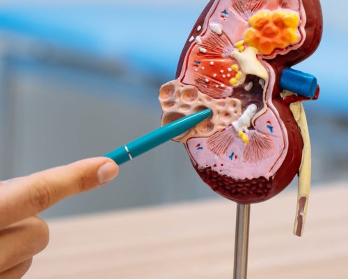 Mengenal URS Cara Menghancurkan Batu Ginjal