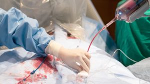 Mengenal Percutaneous Transluminal Coronary Angioplasty (PTCA)