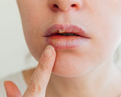 herpes bibir