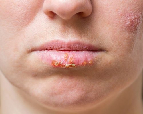 Herpes