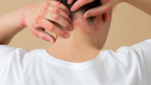 Penyakit Psoriasis: Gejala, Mencegah dan Mengobati