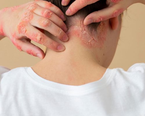 psoriasis