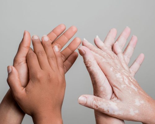 vitiligo