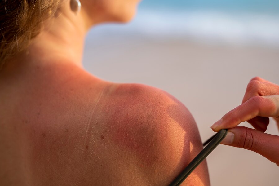 Cara Mencegah Sunburn agar Kulit Tidak Terbakar 