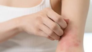 Dermatitis