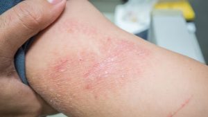 dermatitis kontak