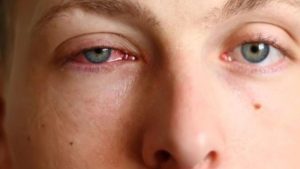kongjungtivitis