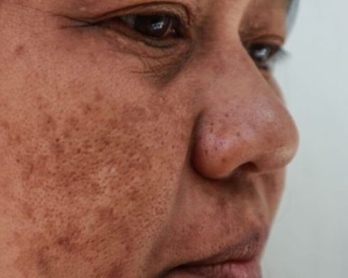 melasma