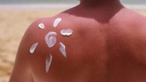sunburn