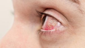 Herpes Zoster Oftalmikus