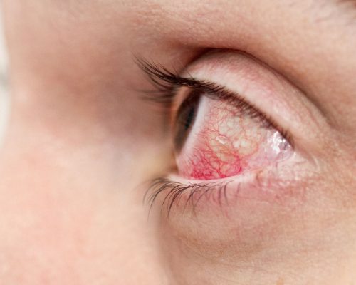 Herpes Zoster Oftalmikus