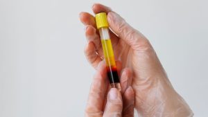 Hiperkolesterolemia