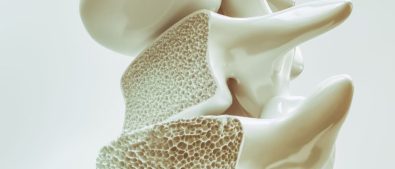 Kenali Osteoporosis