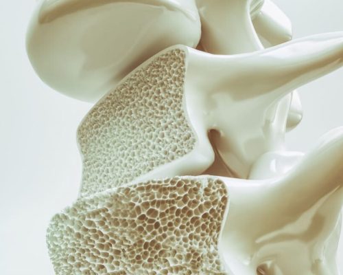 Kenali Osteoporosis