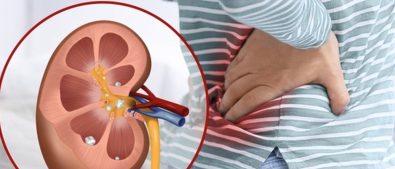 penyebab batu ginjal