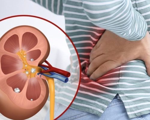 penyebab batu ginjal