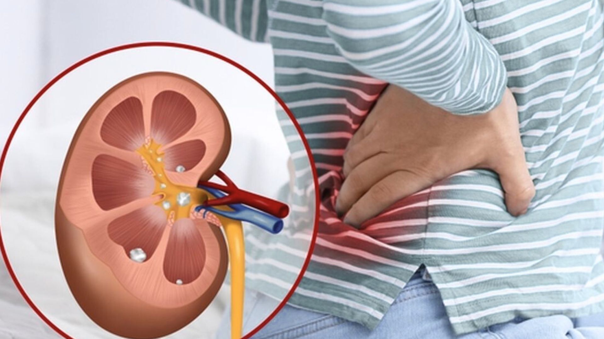 penyebab batu ginjal