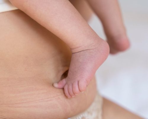 Stretch mark